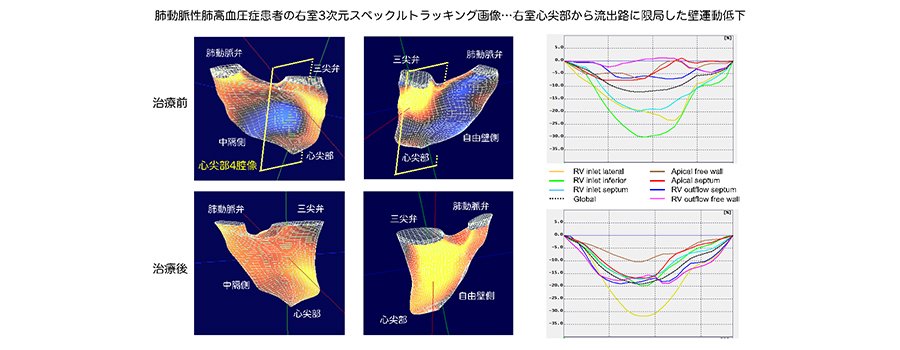 肺動脈性肺高血圧症患者の右室3次元スペックルトラッキング画像‥右室心突部から流出路に限局した壁運動定価